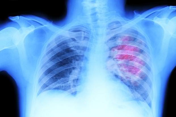 Thoracic Radiotherapy breakthrough for survival in lung