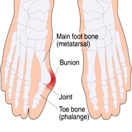 Bunion Surgery, A Helpful Guide